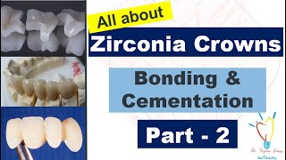 Zirconia Crowns  CEMENTATION vs BONDING [upl. by Hildebrandt267]