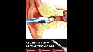 Tvidler The Safest way to remove earwax [upl. by Aicilram245]