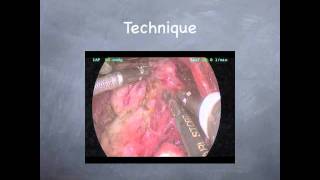 Minimally Invasive Endoscopic Thyroidectomy [upl. by Clarisa]