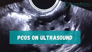 PCOS Sonogram and Discussion [upl. by Roe130]