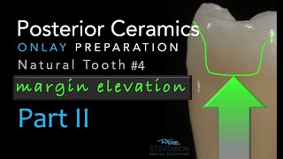 Zirconia Ceramics Part 2 Posterior Ceramic Onlay Preparation  Margin Elevation [upl. by Jacobine]