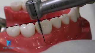 TOOTH PREPARATION FOR ZIRCONIA CROWN [upl. by Lleznod]