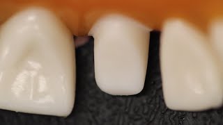 All Ceramic Crown Anterior Tooth Preparation [upl. by Lewanna5]