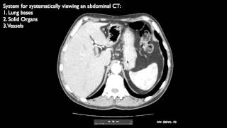 Surgeon Explains Rectal Cancer Surgery [upl. by Airret506]