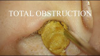 TOTAL OBSTRUCTION  EAR WAX REMOVAL  4KHD [upl. by Brecher]