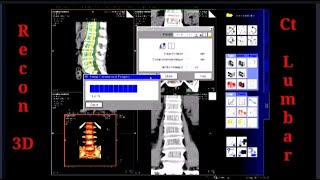 LEARN RECONSTRUCTION CT LUMBAR SCAN  Siemens 16 Slice [upl. by Eelsha]