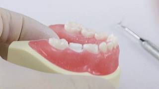 Pediatric Zirconia Crown Technique  Posterior [upl. by Anoiek]