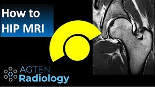 How to Read Hip MRI [upl. by Chlores]