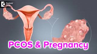 What happens if I have PCOS and I get pregnant  Dr Bala R [upl. by Flossi41]