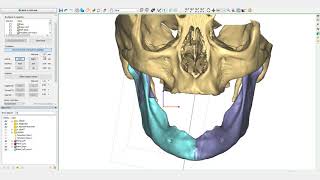 Mandible Reconstruction Tutorial  PROPLAN CMF™ [upl. by Winters]