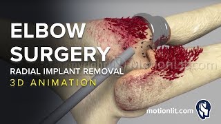 Elbow Surgery Radial Implant Removal  3D Medical Animation [upl. by Ttebroc]