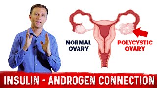 Why Does Insulin Cause PCOS Polycystic Ovary Syndrome – DrBerg [upl. by Aerdnak367]