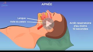 L’apnée du sommeil qu’estce que c’est [upl. by Harleigh]