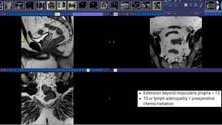 How to read Rectal Cancer MRI [upl. by Tsai647]