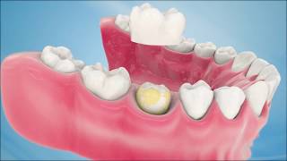 Dental Crown Procedure [upl. by Alhsa14]