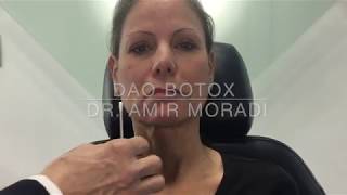 Botox in Depressor Anguli Oris DAO Muscle Dr Amir Moradi San Diego California [upl. by Pearlman937]