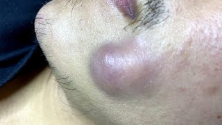 Big Pimples  Mụn Nhọt Siêu To  SacDepSpa158 [upl. by Lecroy]