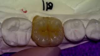 46 Full Zirconia Crown GC LP stain  Cementation [upl. by Townie161]