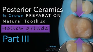 Zirconia Ceramics Part 3 ThreeQuarter Crown Preparation  Using Hollow Grind [upl. by Keelin]