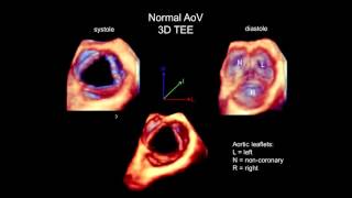 3D Echocardiography Acquisition Cropping and Case Examples [upl. by Low157]