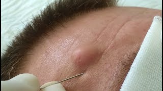 Sebaceous Cyst on FaceАтерома лица [upl. by Cummings105]