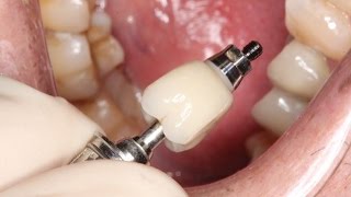 Full Contour Zirconia Implant Crown Insert [upl. by Teodor]