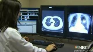 Using CT Scans to Screen for Lung Cancer [upl. by Hallvard]