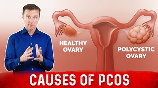 3 Causes of Polycystic Ovarian Syndrome PCOS amp High Androgens – Dr Berg [upl. by Nannahs]