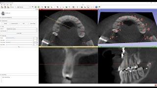 Curved multiplanar reconstruction MPR view in 3D Slicer [upl. by Hartzel]